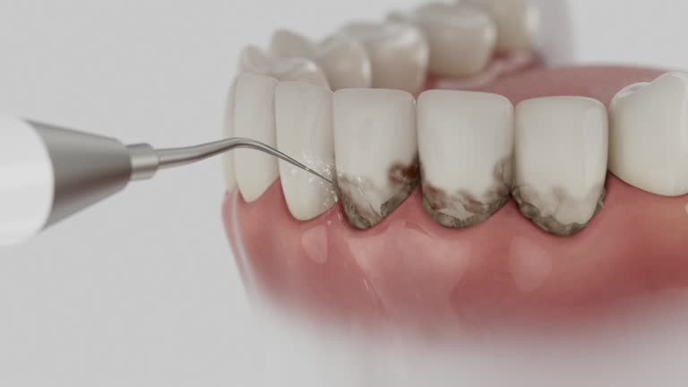 Trusted Tooth Extraction service in Social Circle, GA - Dentist Open Now